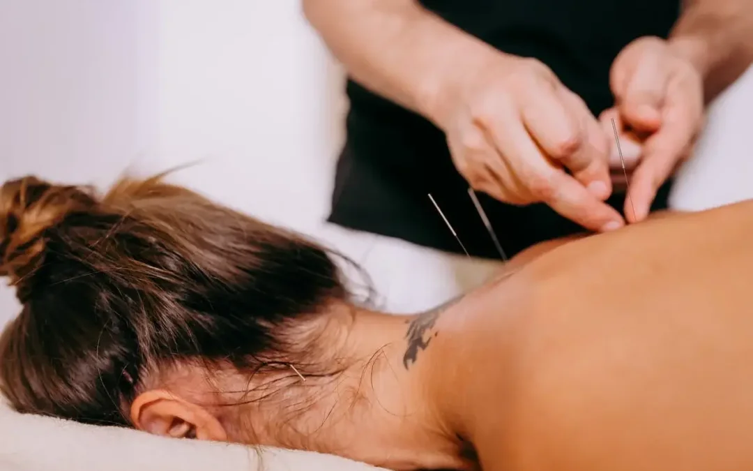 Top 3 Acupuncture Benefits in Nanaimo